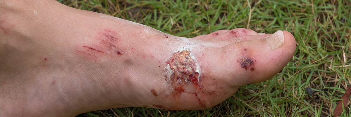 Resultado de imagen para úlceras del pie