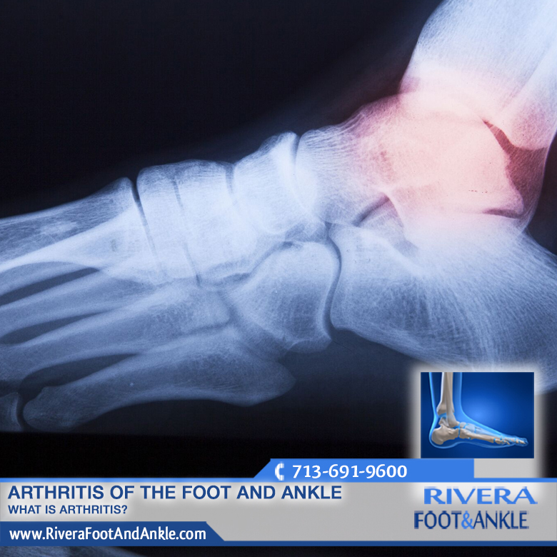 040816 Arthritis