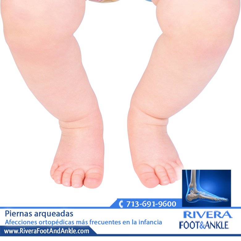 270816 piernas arqueadas
