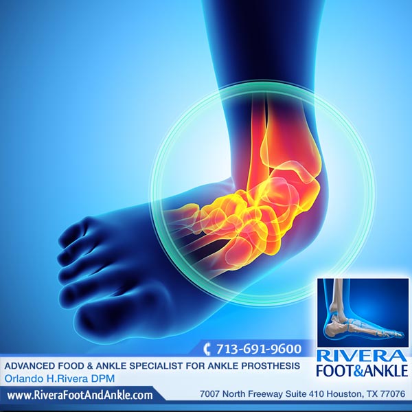 291116 Specialist for Ankle Prosthesis in houston