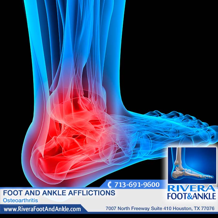 171216 Houston Foot and Ankle Surgeon