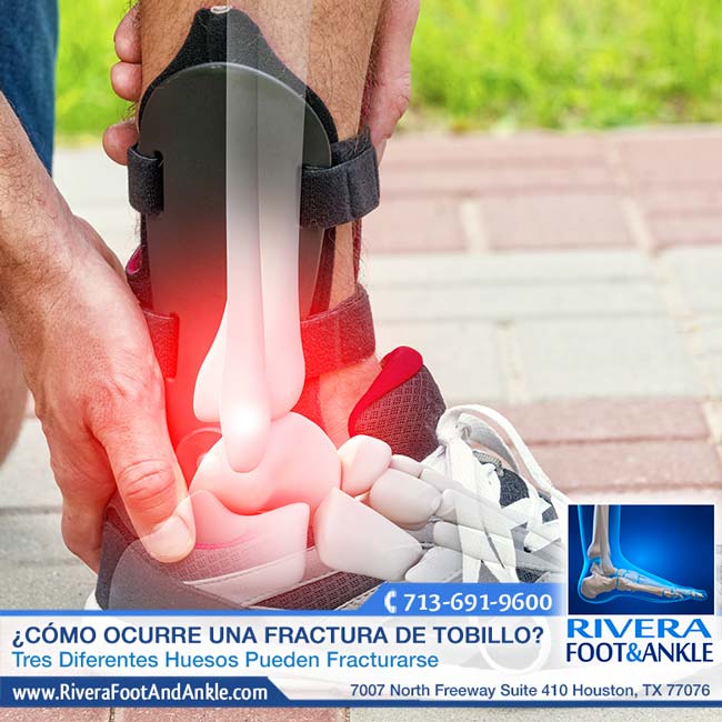 012417 fractura de tobillo doctor en houston
