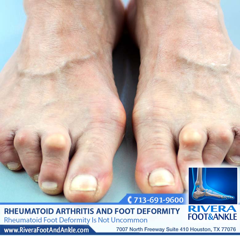 210118 Rheumatoid Foot Deformity Is Not Uncommon