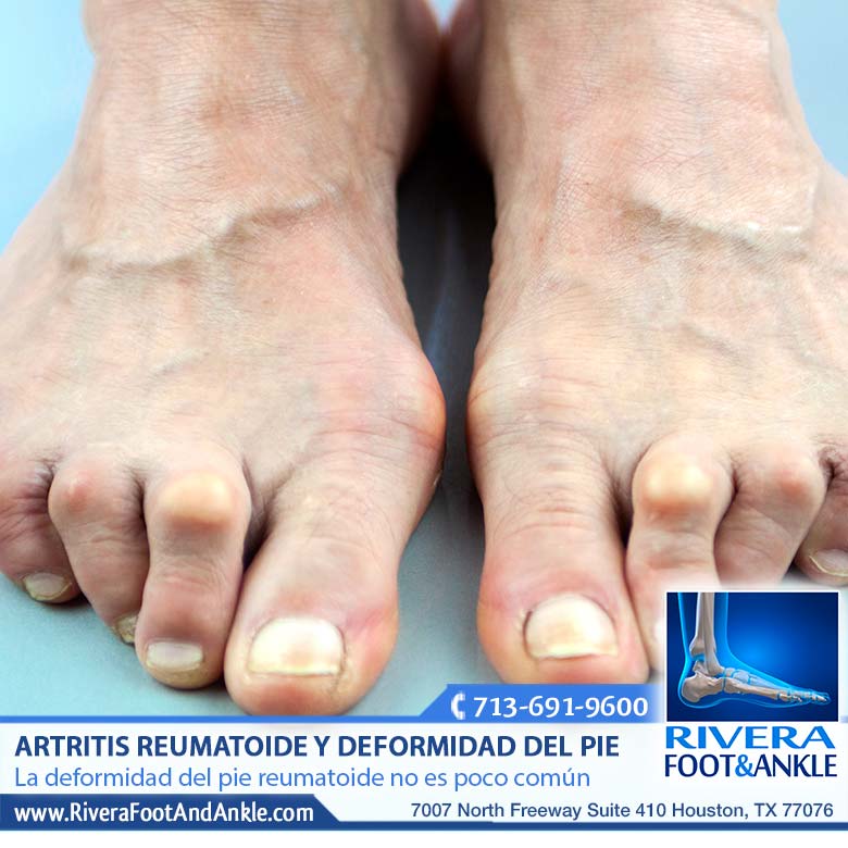 220118 Artritis reumatoide doctor en houston