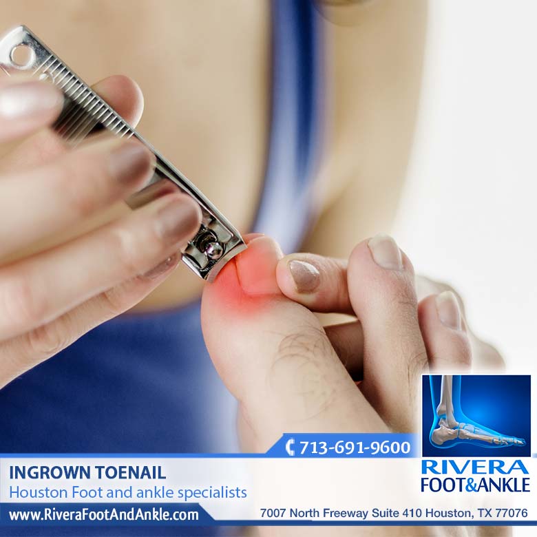 310118 Ingrown Toenail Houston Texas