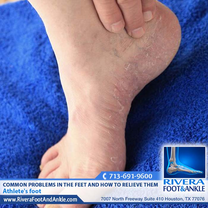 010418 Athletes foot doctor in Houston TX