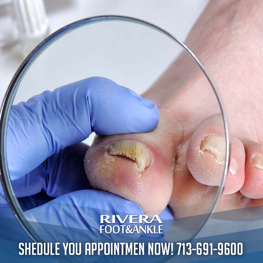 06 How to prevent toenail fungus
