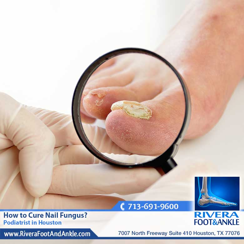 16 How to Cure Nail Fungus