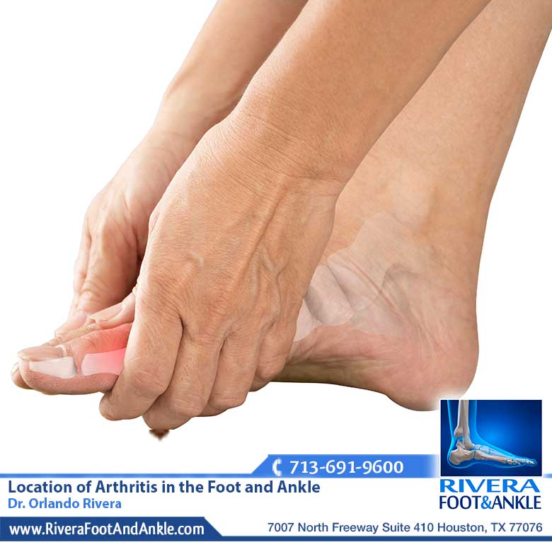 22 Location of Arthritis in the Foot and Ankle