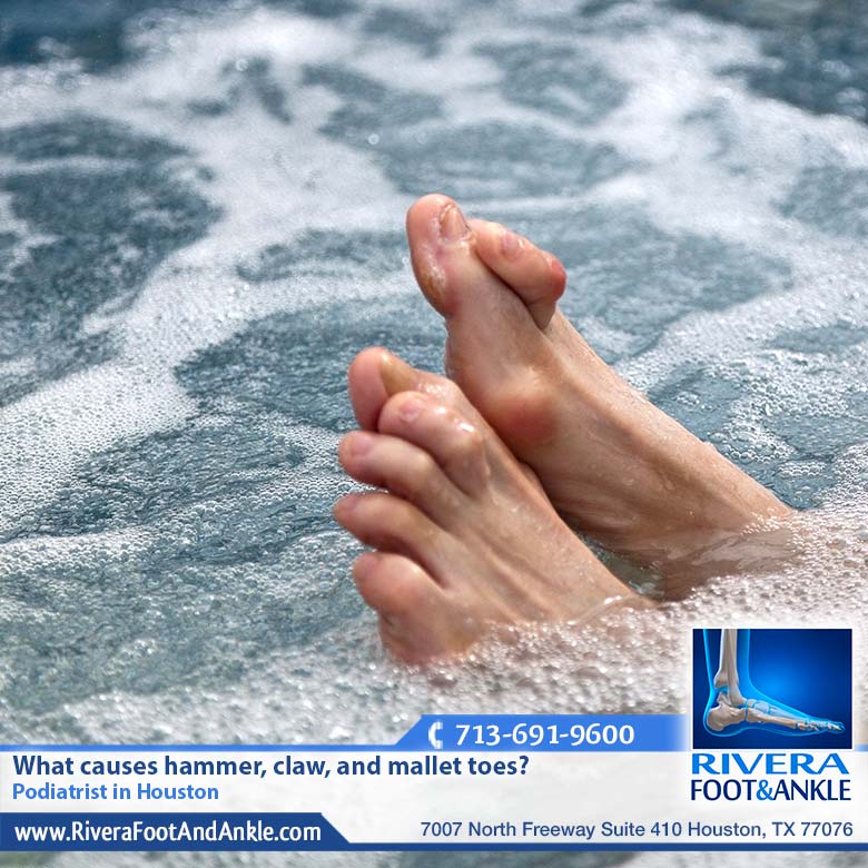 06 What causes hammer claw and mallet toes