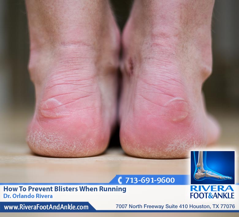 22 Blisters
