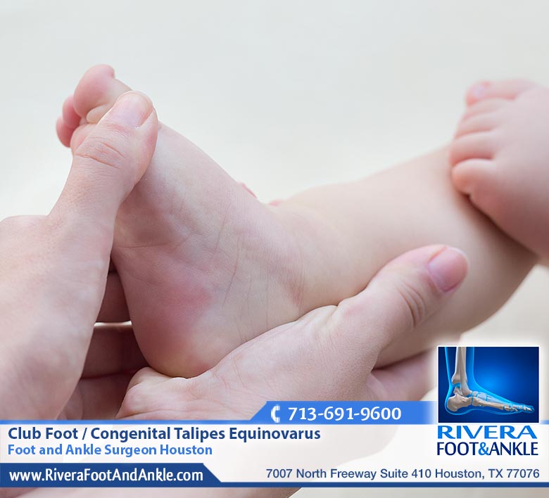 26 Club Foot