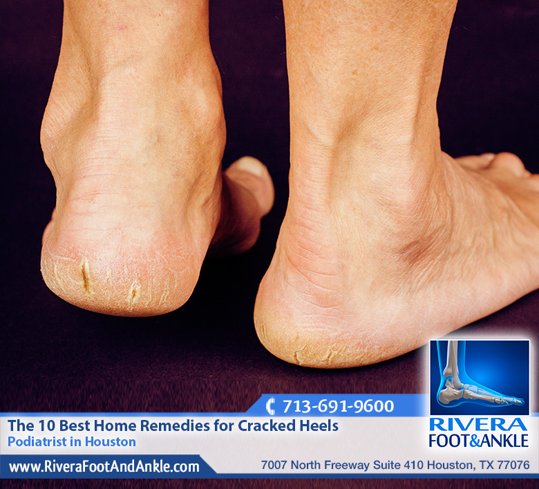 02 Cracked Heels