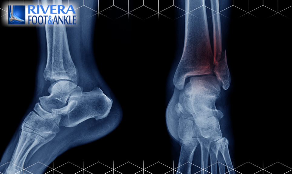 02 Tibia and Fibula Fractures