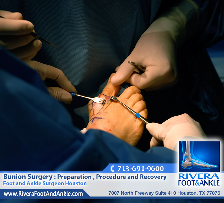 06 bunion surgery