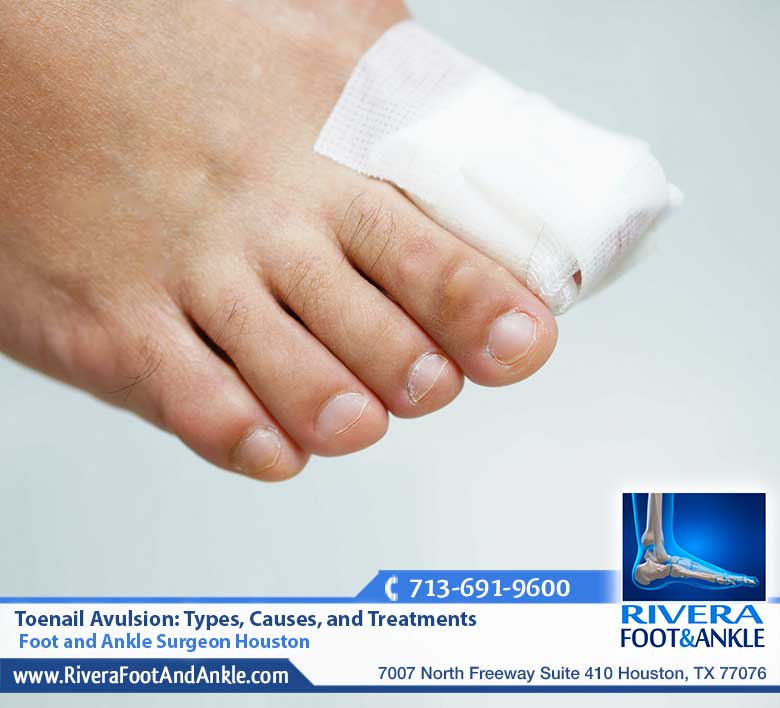 12 Toenail Avulsion