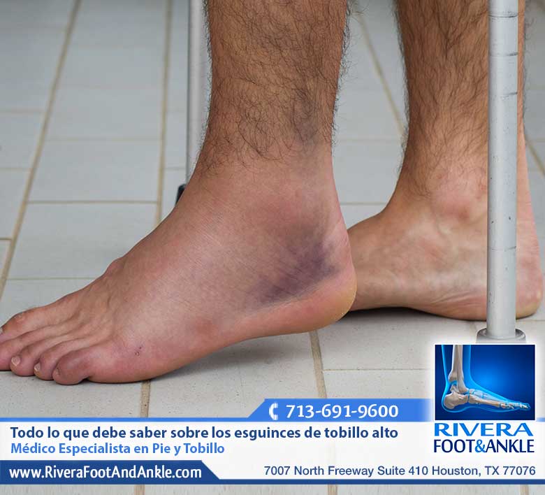 25 Esguinces de tobillo alto