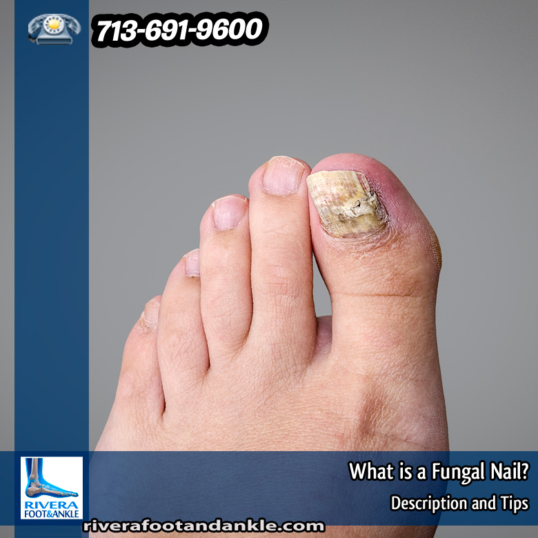 13-what-is-a-fungal-nail