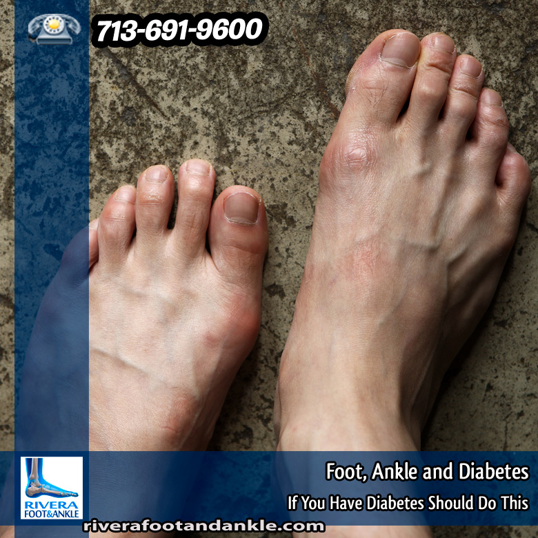 15-foot-ankle-and-diabetes