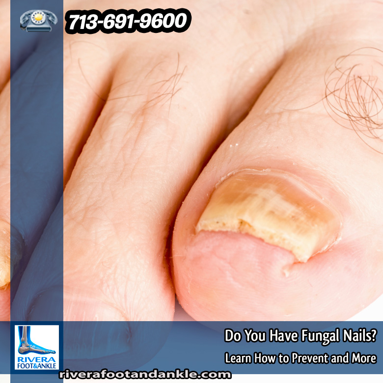 29-do-you-have-fungal-nails