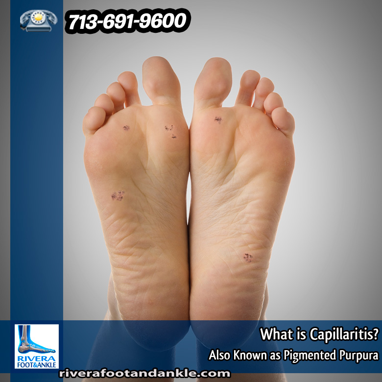 23-what-is-capillaritis