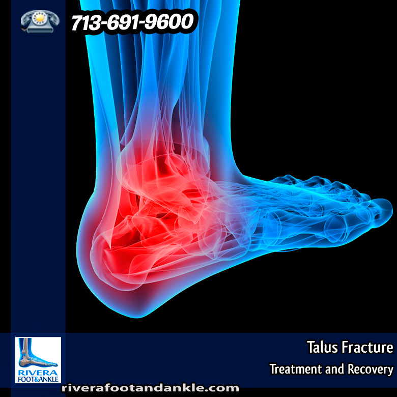 19-talus-fracture
